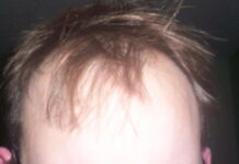 What is Minoxidil, and Explain the Side Effects of Minoxidil? Minoxidil