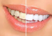5 Advantages of Professional Teeth Whitening by a Cosmetic Dentist Teeth Whitening